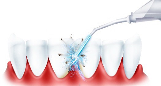 Ирригатор эффективно очищает даже труднодоступные места в полости рта